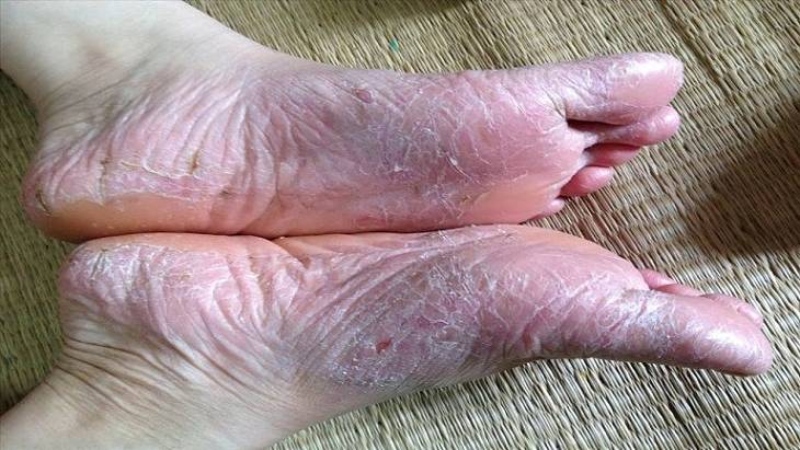 Da chân bị tróc vảy trắng là do bị bệnh lý về da