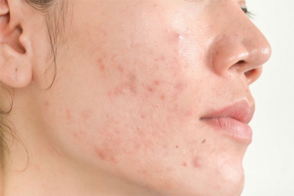 Thay đổi nội tiết tố dẫn đến sự hình thành mụn