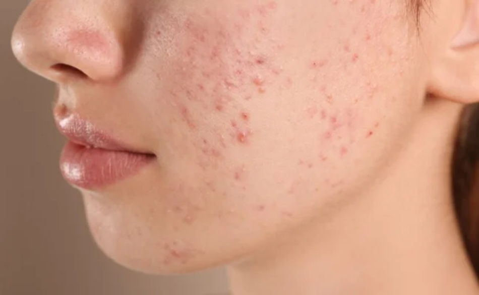 Dấu hiệu nhận biết làn da dầu mụn