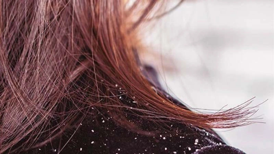 Tại sao nhuộm tóc xong bị gàu?
